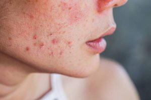 Let's Talk Acne!