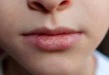 Are You Peeling Lips? Here Are 7 Remedies For Chapped Lips Are You Peeling Lips? Here Are 7 Remedies For Chapped Lips