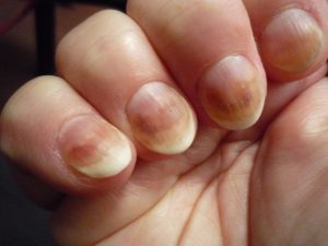 Are Damaged Nails And Cancer Related?