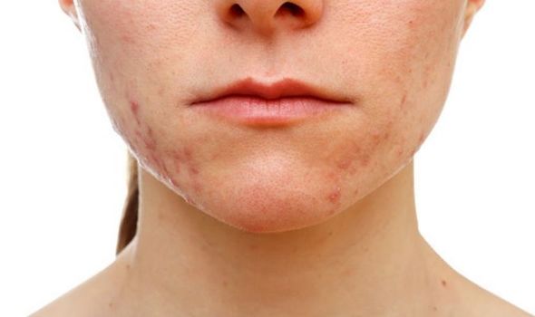 What is acne face mapping, and why do we break out in particular areas?
