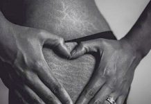 How to Get Rid of Stretch Marks : 11 Treatment Options Stretch Marks